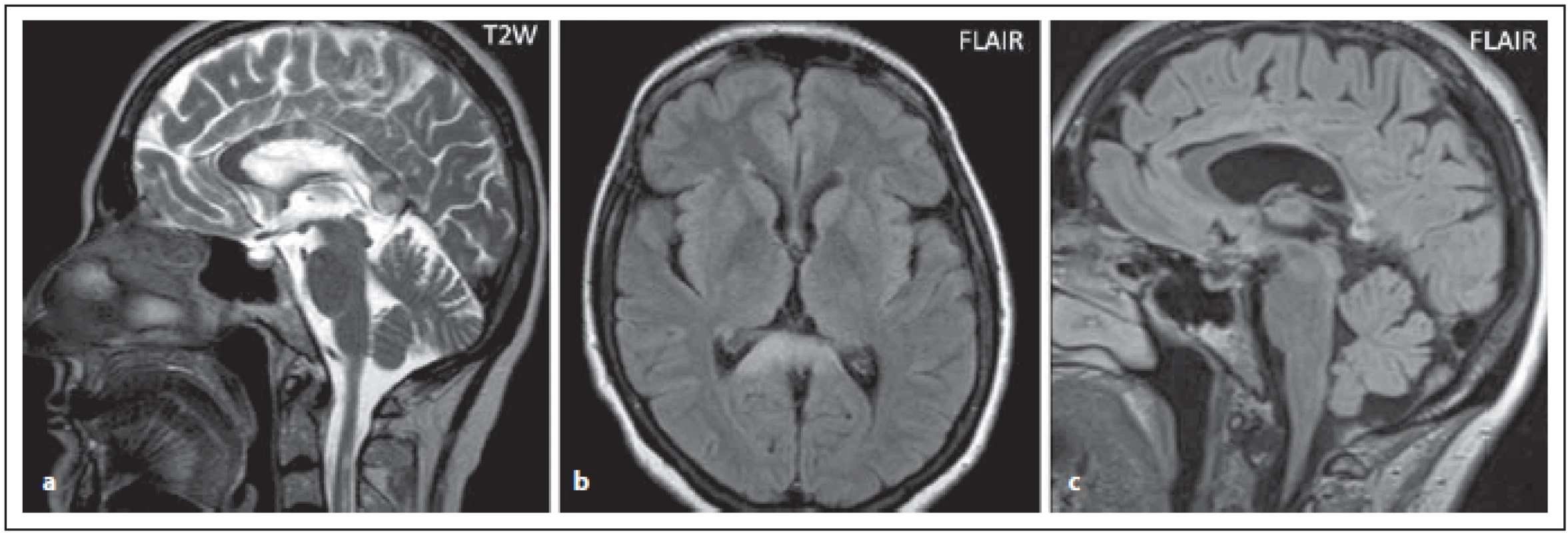 Pacient s AQP4-IgGpozNMOSD, v sagitální rovině v T2 váženém obraze jsou patrná vícečetná, místy rozsáhlejší
ložiska v oblasti corpus callosum (a), rozsáhlé ložisko v oblasti splenia detailněji zobrazeno v transverzální rovině v sekvenci
FLAIR (b). Při kontrole za 2 roky je patrná výrazná redukce ložiskového postižení s výraznou atrofi zací corporis callosi (c).<br>
Fig. 6. AQP4-IgGposNMOSD patient, T2-weighted image, sagittal cut, multiple (and more extensive in some places) lesions
in corpus callosum (a), FLAIR, extensive lesion in the splenium (b). Signifi cant atrophy of the corporis callosi is observed at 2-year
follow-up (c).