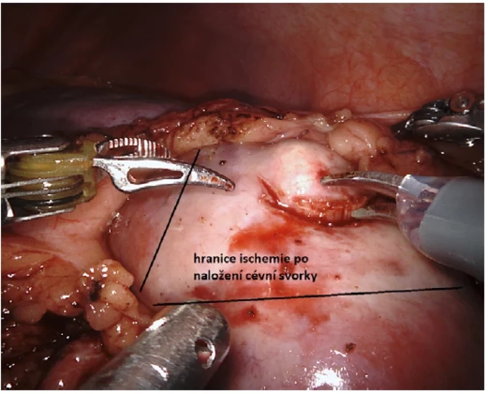 Hranice ischemie po naložení cévní svorky <br> 
Fig. 5. Ischemia boundaries after loading of the vascular clamp