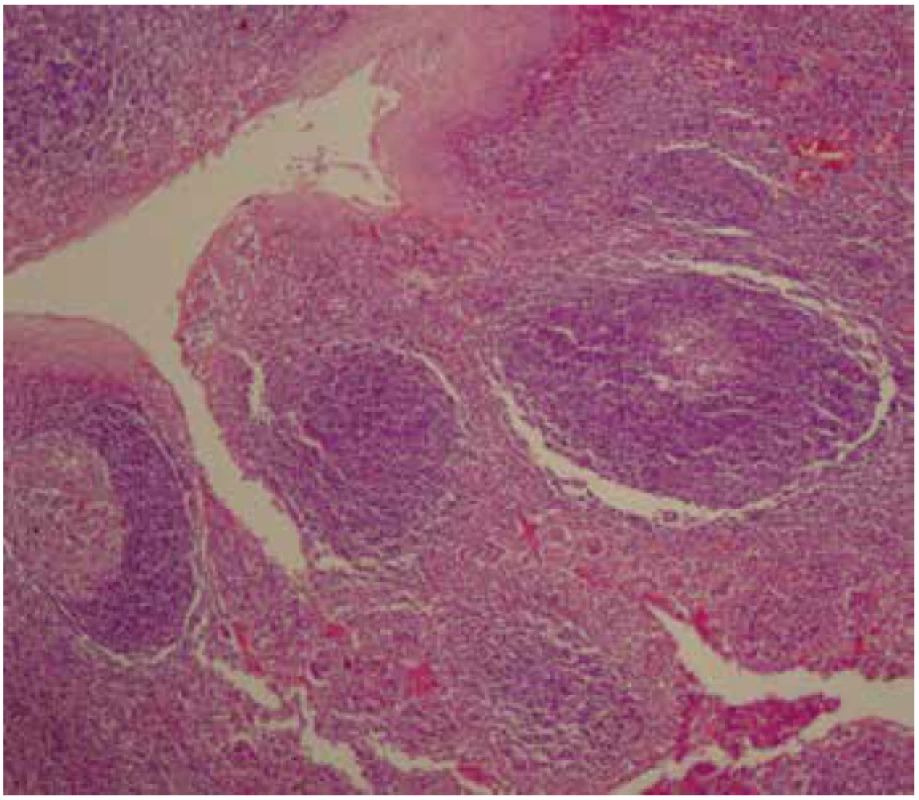 Normal structure of the right palatine tonsil (H&E, 140x).