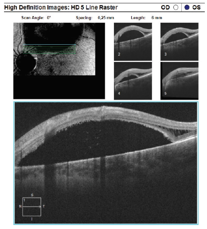 HD-OCT: Lineární horizontální transretinální
sken levého oka vedený v superotemporální peripapilární
oblasti s patrnou rozsáhlou oblastí vysoké serózní ablace
neuroretiny s akumulací tekutiny subretinálně, v temporálních
oblastech opět patrná schíza retinálních vrstev
sítnic