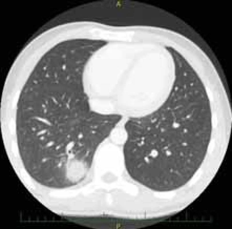 Solitární ložisko plic.<br>
Fig. 3. Solitary lung focus.