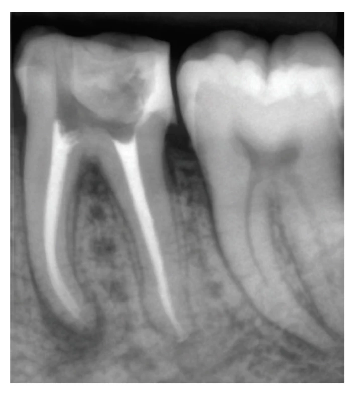 koreňové kanáliky zaplnené
polyepoxidovým sealerom
AD Seal™ a gutaperčou<br>
Fig. 4
Root canal obturated
with poly-epoxide sealer
AD Seal™ and gutta-percha