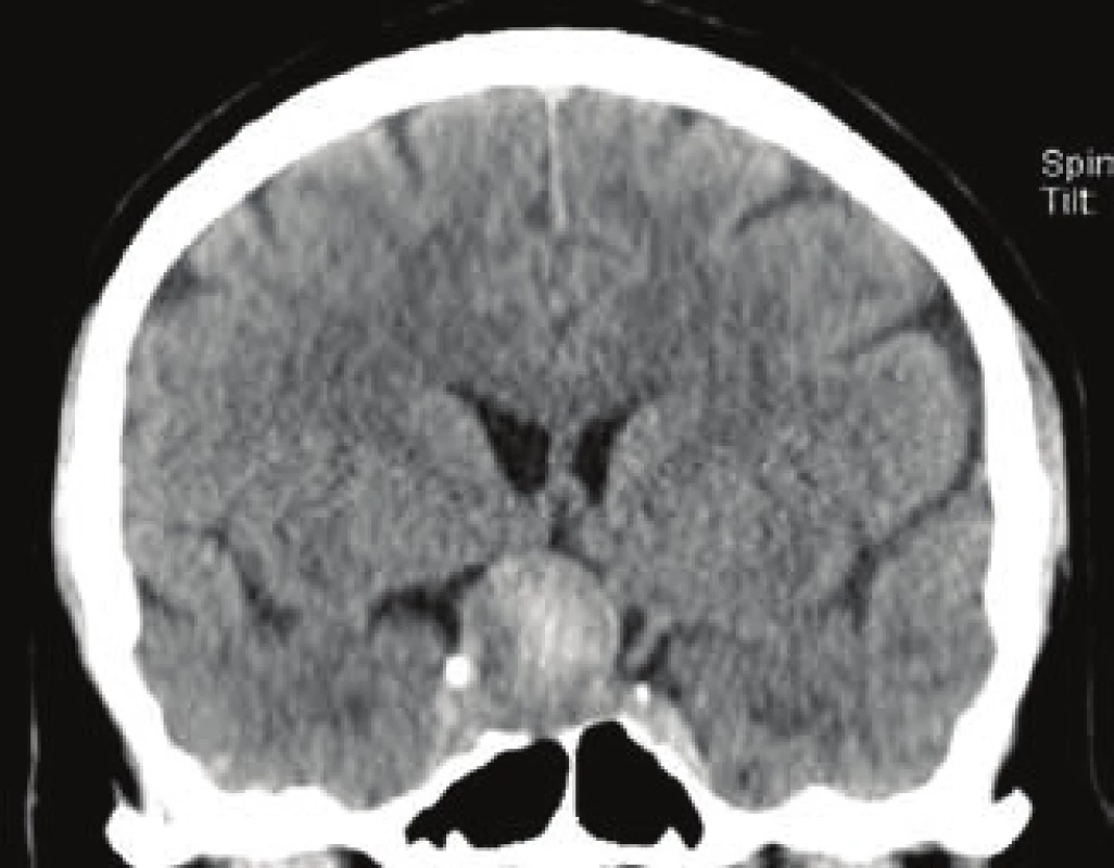 Complete thrombolisation of aneurysm