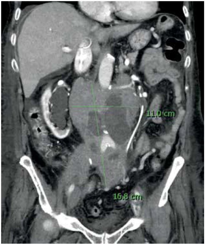 B-lymfom retroperitonea, hydronefróza pravé ledviny<br>
Fig. 4. B-lymphoma in the retroperitoneum, hydronephrosis
of the right kidney