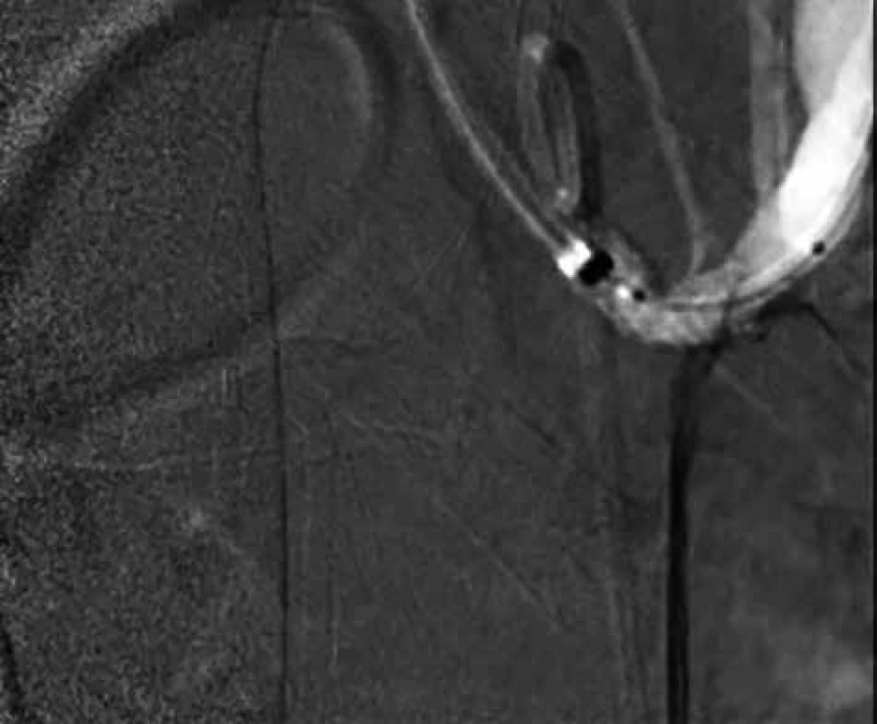 PTA stenózy kmene TC se zavedením stentu – 
snímky digitální subtrakční angiografie<br>
Fig. 4: PTA of the TC stenosis with the placed stent – images 
of digital subtraction angiography