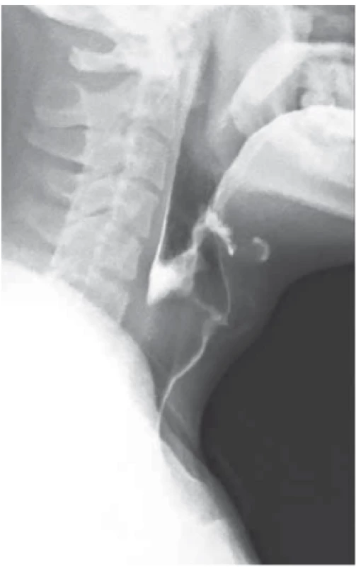 RTG snímek zaklíněného sousta v oblasti jugula se známkami aspirace kontrastní látky.<br>
Fig. 1. X-ray picture of food stuck in
jugular area with signs of contrast
aspiration.