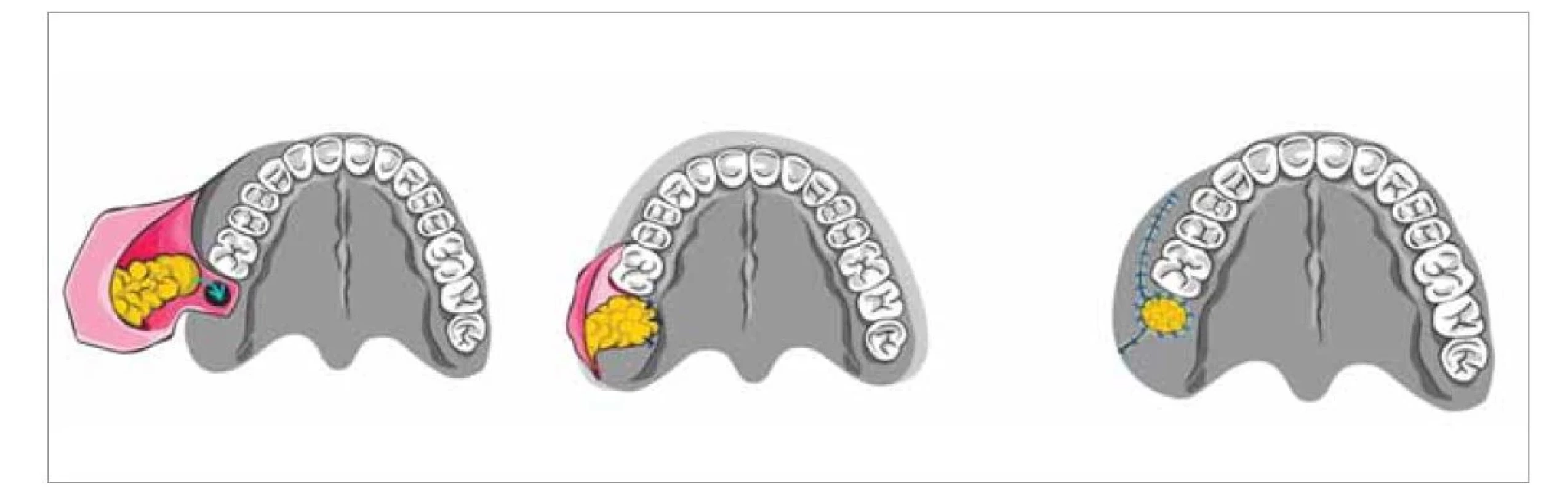 Lalok s tvářovým tělesem.<br>
Fig. 5. Buccal fat pad.