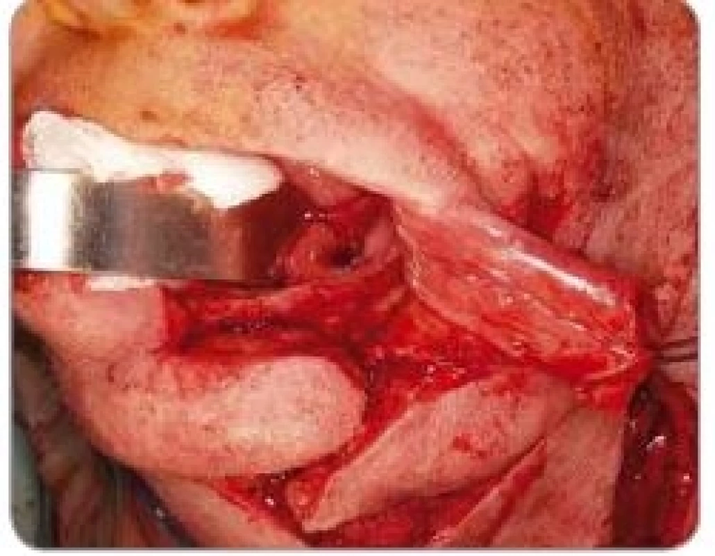 Surgical access to a metastasis in scull base.