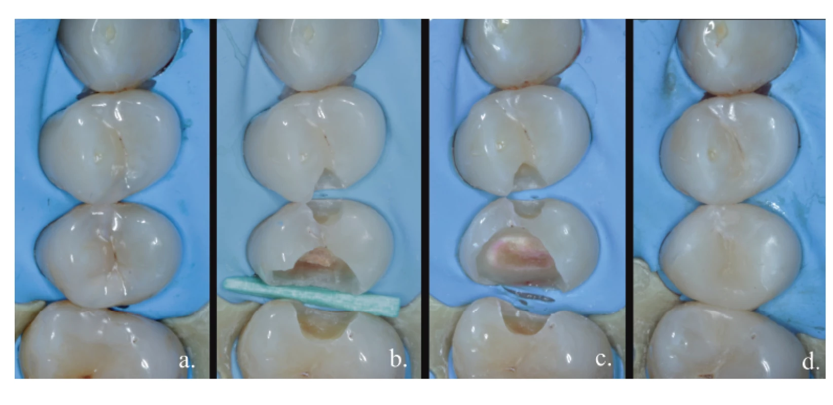 Totální exkavace;<br>
a. výchozí stav,<br>
b. otevření kariézního ložiska,<br>
c. dokončení preparace
– po obarvení detekčním
barvivem,<br>
d. definitivní výplň<br>
Fig. 2<br>
Total excavation;<br>
a. before treatment,<br>
b. opening of the carious
lesion,<br>
c. finishing the preparation –
after staining,<br>
d. permanent filling