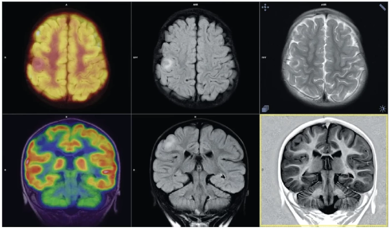 Sedmnáctiměsíční dívka s nekorigovatelnou epilepsií, kortikální dysplazie v pravé hemisféře, interiktální vyšetření ukazuje snížení
metabolické aktivity ve tkáni dysplazie, vyšetření s 18F-FDG, PET/MRI fúze v pravém sloupci, uprostřed TIRM T2 FLAIR obrazy, vpravo nahoře
TSE T2, vlevo dole TIR T1 sekvence