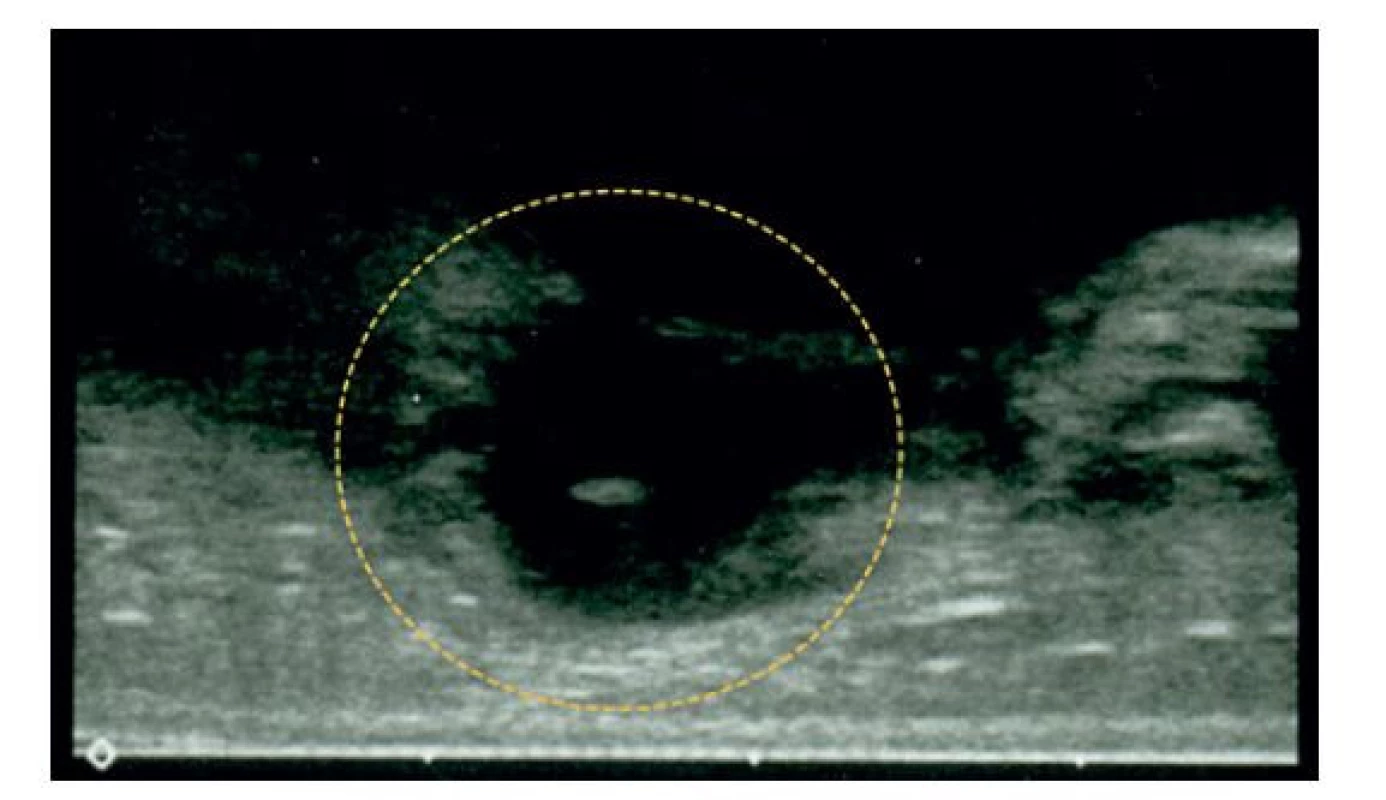 Distrahovaný mediální epikondyl zachycený na ultrazvukovém
vyšetření<br>
Fragment není inkarcerován v kloubu.<br>
Fig. 3: Ultrasound image of the displaced medial epicondyle<br>
The fragment is not interposed in the elbow joint.