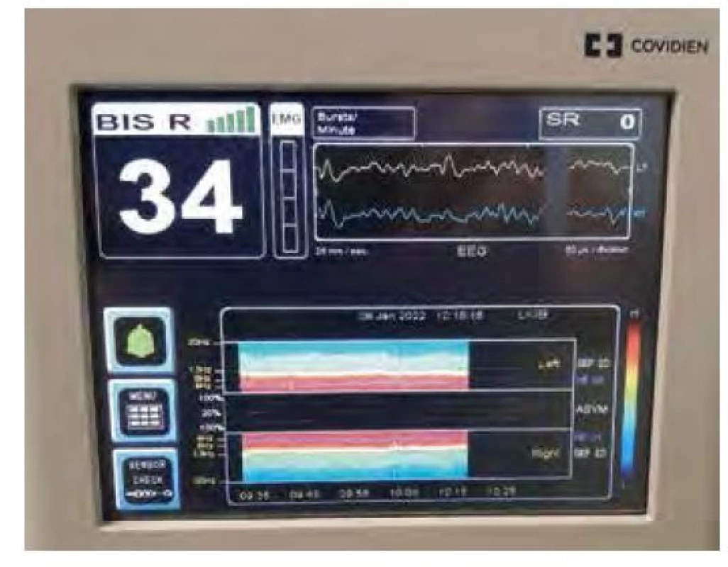 Displej monitoru BIS zobrazuje index hloubky anestezie BIS měřený
z pravé strany čela, nulovou aktivitu na EMG, dva svody EEG. Bursty nebyly
zjištěny, proto je SR (Suppression Ratio) 0. V dolní části je zobrazena spektrální
analýza EEG (viz další článek)