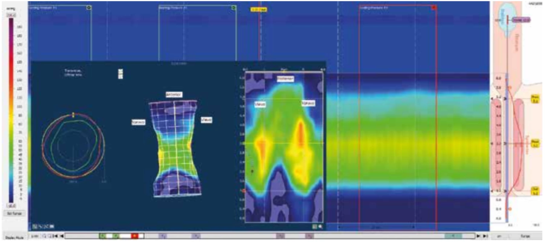 Normální nález – klidový tlak
Vlevo 3D model tlakových poměrů análního kanálu v klidu. Čím teplejší barva, tím vyšší tlak. Uprostřed rozložený 3D model do
2D zobrazení k usnadnění stranové orientace. Vpravo 2D záznam z high resolution anorektální manometrie. 3D zobrazení s viditelnou fyziologickou asymetrií tlaků v análním kanále. Vyšší tlak v zadní proximální oblasti (koreluje se smyčkou m. puborectalis)
a v přední distální oblasti a laterálně (koreluje s externím svěračem). Zdroj: Archiv oddělení gastrointestinální endoskopie, Ústřední
vojenská nemocnice − Vojenská fakultní nemocnice, Praha. <br>
Fig. 1: Normal finding – resting pressure
On the left, a 3D model of the pressure conditions of the anal canal at rest. The warmer the color, the higher the pressure. In the
middle, unfolded 3D model into a 2D view to facilitate lateral orientation. On the right, 2D record of high resolution anorectal
manometry. 3D view with visible physiological asymmetry of pressures in the anal canal. Higher pressure in the posterior proximal
region (correlates with the puborectalis loop) and in the anterior distal region and laterally (correlates with the external sphincter).
Source: Department of Gastrointestinal Endoscopy Archive, Military University Hospital, Prague.