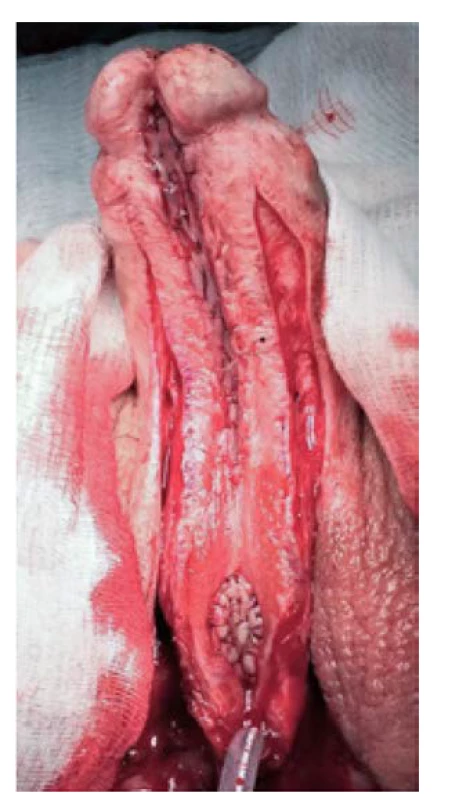 Aplikace bukálního štěpu dorzálně
inlay dle ASOPY<br>
Fig. 5. Dorsal inlay bucal mucosal
graftig according to ASOPA