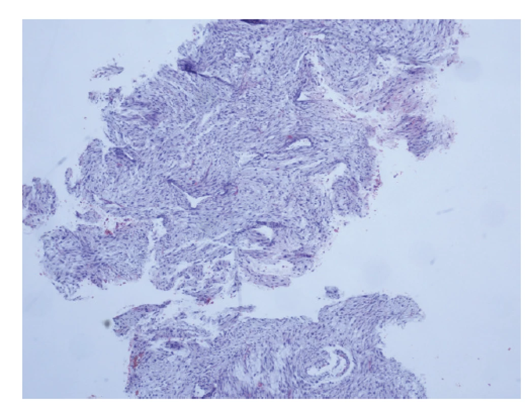 Core cut biopsie, fragment pocházející z fibroadenomu,
nelze vyloučit přítomnost fyloidního nádoru.<br>
Fig. 4: Core cut biopsy, fragment of fibroadenoma, the
presence of a phyllodes tumor cannot be excluded.