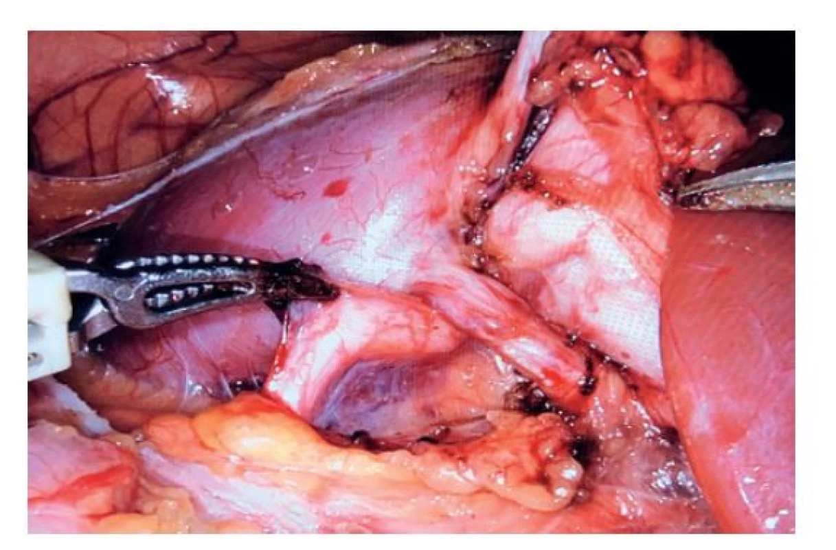 Aberantní cévní svazek – nejčastější příčina obstrukce
PUJ v našem souboru<br>
Fig. 2: Aberrant vessel – the most common cause of PUJO
in our cohort