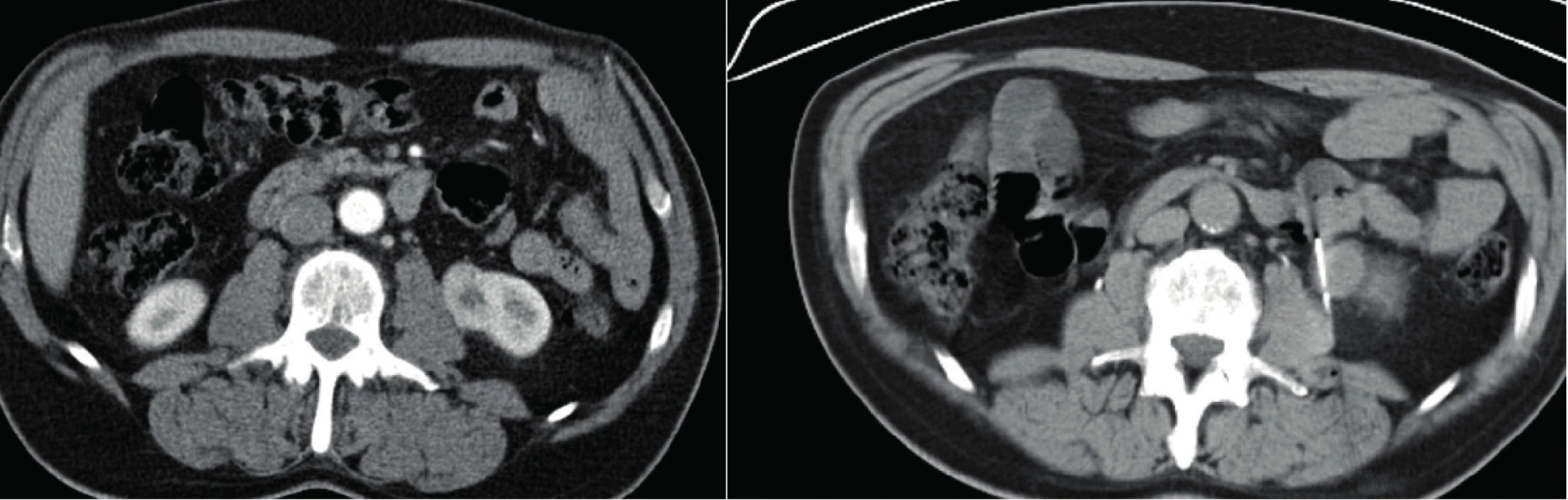 CT, transverzální řez. Muž, 50 let. Vlevo CT snímek před biopsií s popisem tumoru levé ledviny, suspektní
onkocytom. Vpravo snímek během biopsie. Histologicky potvrzený onkocytom<br>
Fig. 4. CT scan, transverse plane. A fifty year old male. In the left picture – CT scan prior to the biopsy with the
description of the tumor of the left kidney, oncocytoma suspected. In the right picture – CT scan during the biopsy.
Histologically confirmed oncocytoma