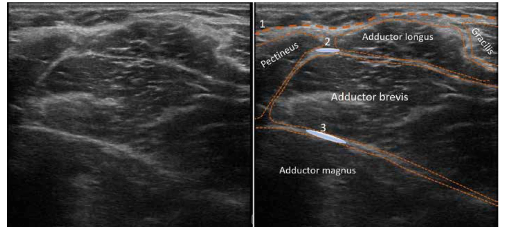 Ultrazvukový obraz proximální mediální části stehna. 1. fascia lata, 2. aplikační oblast pro blokádu n. obturatorius anterior, 3. aplikační oblast
pro blokádu n. obturatorius posterior