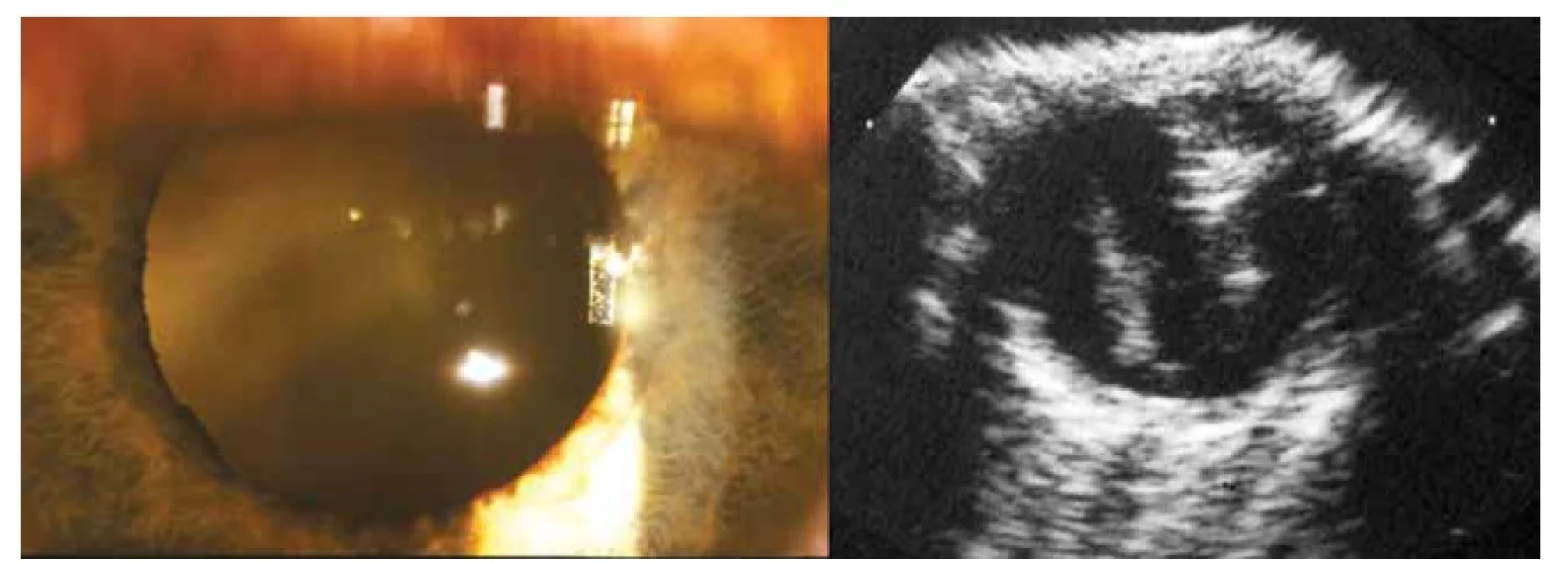 Vlevo: Zkalení sklivce toxokarové etiologie patrné retrolentálně<br>
Vpravo: Ultrazvukový obraz toxokarové endoftalmitidy se zánětlivými konglomeráty sklivce a trakčním pruhem jdoucí od papily
do periferie sítnice