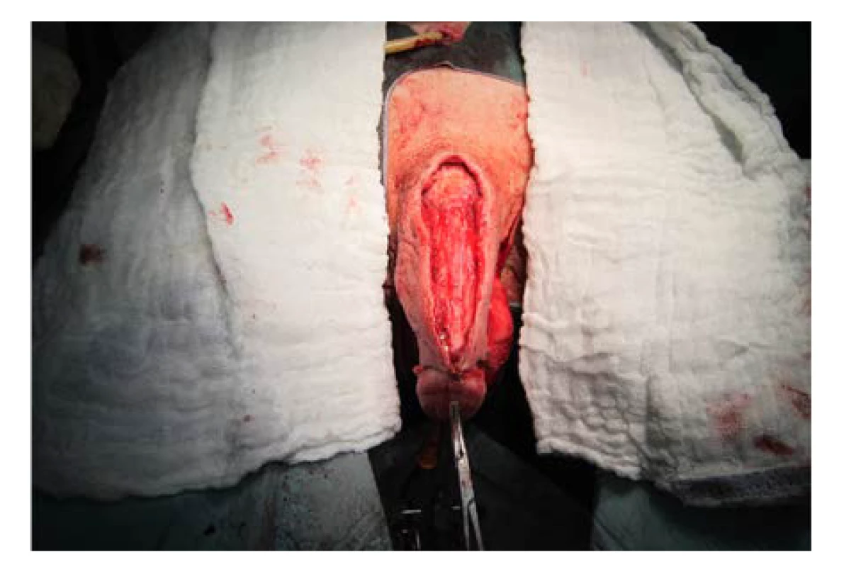 Fixace laloků pod corona glandis, stav před
suturou na ventrální straně penisu<br>
Fig. 8. Flap fixation under the corona of glans penis;
the state prior to suturing at the ventral side of the
penis