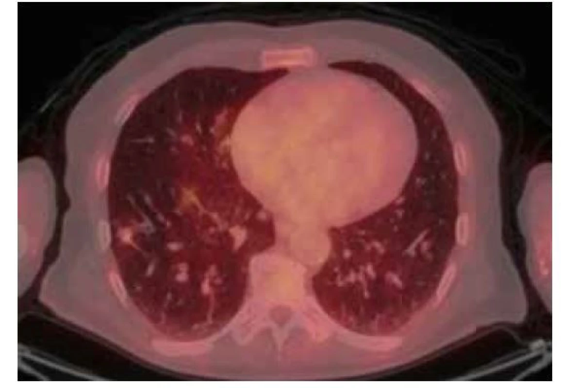 18F-FDG PET/CT vyšetření hrudníku před resekcí suspektního
ložiska – zobrazuje se mírná akumulace FDG v ložisku v dolním laloku
pravé plíce vel. 14 x 13 x 10 mm (SUVmax 1,2)