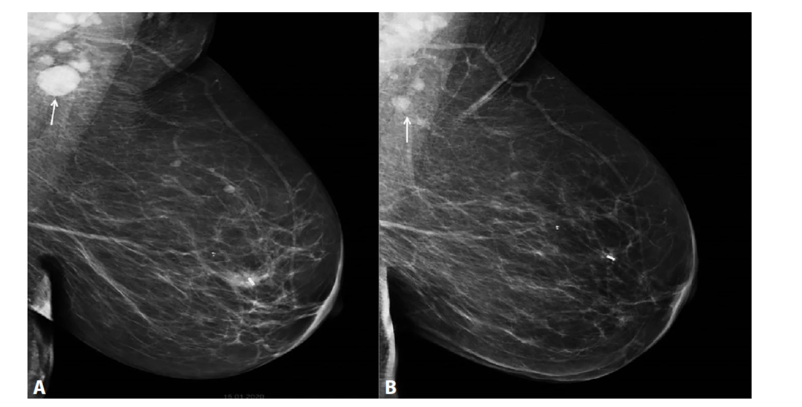 MG l. sin MLO projekce<br>
A) Před NCHT. Centrálně v levém prsu neostře ohraničená denzita, odpovídá invazivnímu NST ca, tumor označený klipem.
Denzní zvětšená patologická lymfatická uzlina v levé axile (označena šipkou). B) Po NCHT. Centrálně v levém prsu
klip, bez rezidua ca. V levé axile výrazná regrese patologické lymfatické uzliny (označena šipkou).<br>
Fig. 6: MG l.sin MLO projection<br>
A) Before NCT. A mass of irregular density centrally in the left breast, corresponding to invasive NST cancer; the tumour
is marked with a clip. Dense, enlarged, pathological lymph node in the left axilla (arrow). B) After NCT. Centrally located
clip in left breast with no residual tumour. Significant regression of the pathological lymph node in the left axilla
(marked by the arrow).