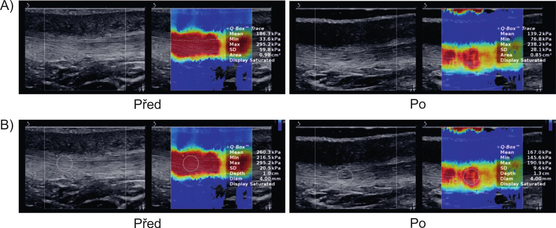 Všechny demonstrované snímky představují kvantitativní ohodnocení střihového napětí (shear stress) ve vazu ligamentum patellae. Snímky se vztahují ke stavu před podáním vysokoindukční magnetické stimulace a ke stavu krátce po podání procedury. Obrázky demonstrují měření v celé na snímku zachycené části vazu (A) a měření v místě maximální tuhosti vazu (B). Převzato z práce (13). 