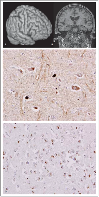 MR a neuropatologie 
u frontotemporální demence 
s amyotrofi ckou laterální sklerózou.<br>
Fig. 3. MRI and neuropathology in frontotemporal dementia and a myotrophic lateral sclerosis.