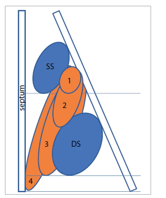 Klasifikace postižení nosní dutiny
pomocí Nasal polyp score.
SS – střední skořepa, DS – dolní skořepa,
1 – polyp po dolní hranu střední
skořepy, 2 – polyp pod dolní hranu
střední skořepy, 3 – polyp po dolní
hranu dolní skořepy nebo polyp mediálně
od střední skořepy, 4 – polyp po
spodinu dutiny nosní<br>
Fig. 2. Classification of nasal involvement
using the Nasal polyp score.
SS – middle turbinate, DS – lower turbinate,
1 – polyp to the lower edge of
the middle turbinate, 2 – polyp below
the lower edge of the middle turbinate,
3 – polyp to the lower edge of the lower
turbinate or polyp medially from the middle
turbinate, 4 – polyp to the base of
the nasal cavity