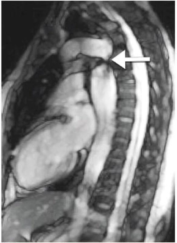 Koarktace aorty (označeno šipkou) při vyšetření magnetickou
rezonancí (archiv autorů).<br>
Fig. 2. Magnetic resonance imaging in native coarctation of
the aorta (authors archive).