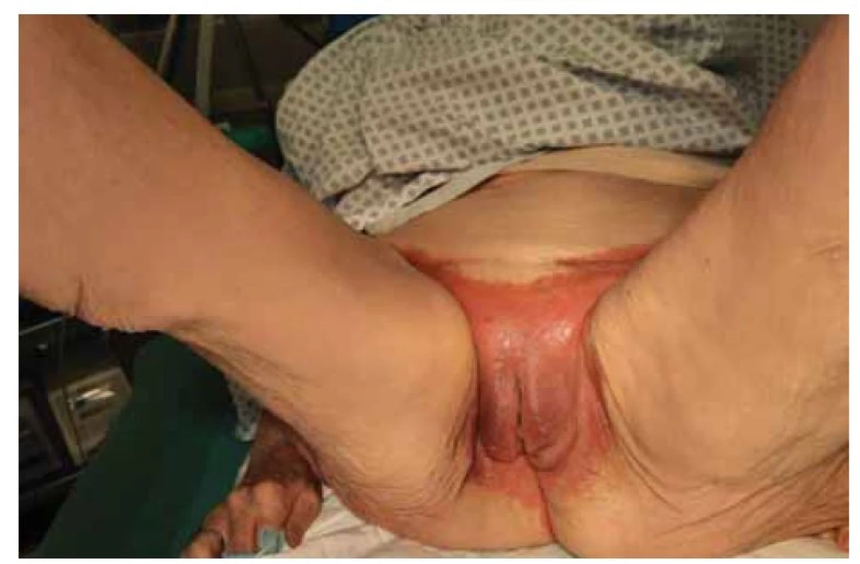 Rozsáhlá kožní léze.<br>
Fig. 1. Extensive skin lesions.