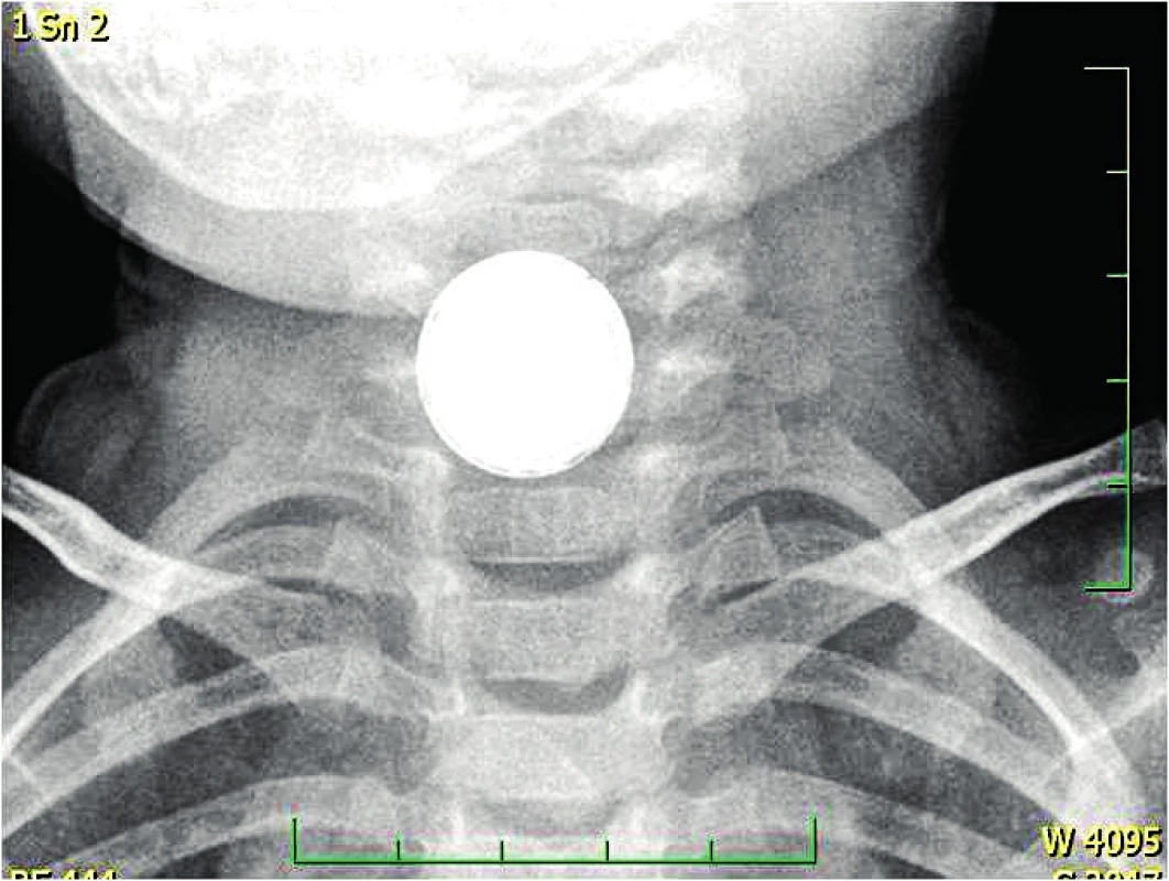 Baterie v jícnu, dvojitý lem. <br><b>Fig. 2.</b> Battery in the esophagus, double ring.