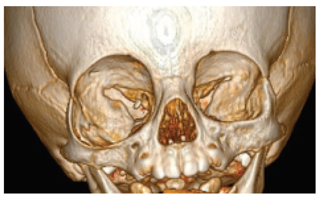 CT examination at the age of 9 months with 3D reconstruction
of facial skeleton, with evident enlargement
of the right orbit
