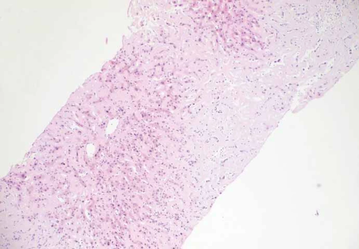 Amyloidóza jater (růžová hmota) a zbytky trámců jaterních buněk.
Fig. 1. Liver amyloidosis (pink substance) and remnants of liver cell plates.