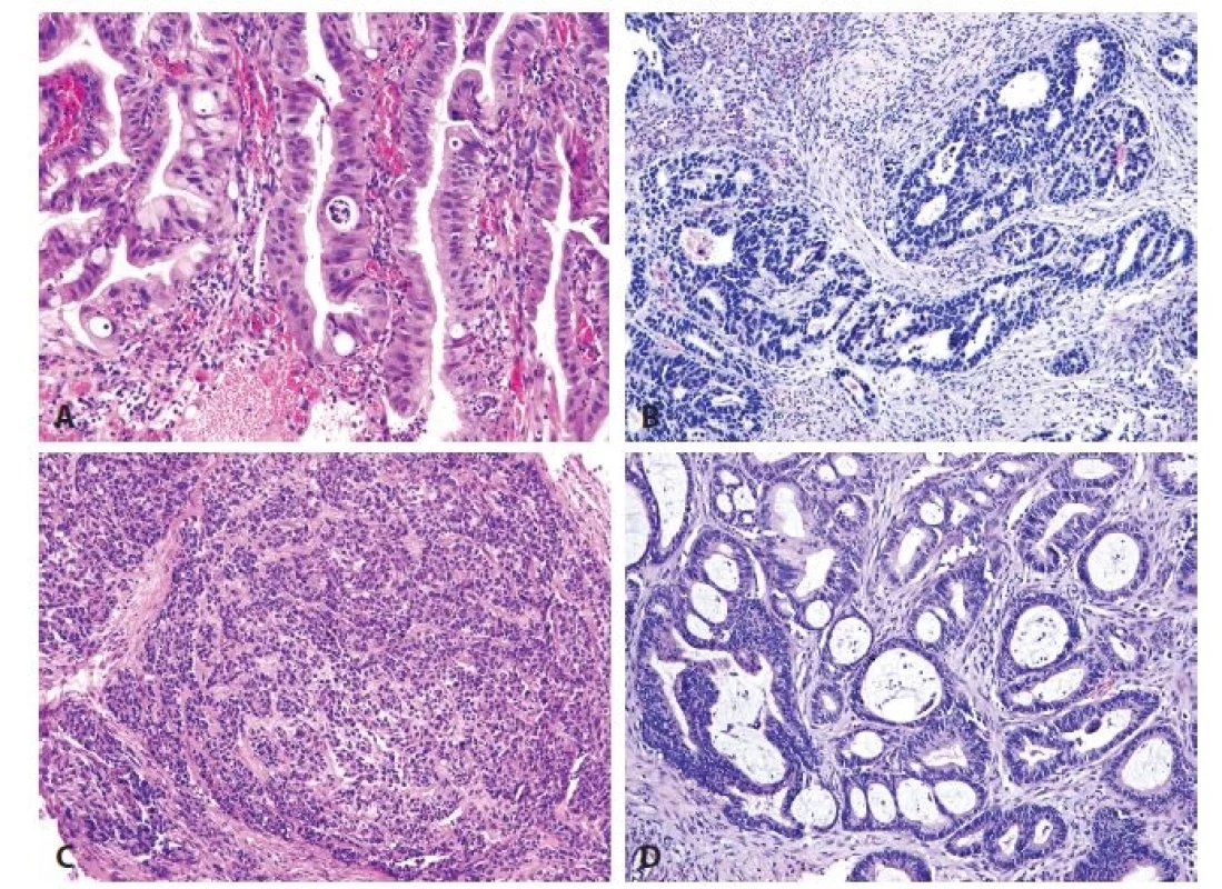 A. High-grade dysplasia. B. Esophageal adenocarcinoma of intestinal type. C. Esophageal adenocarcinoma of foveolar gastric
type, with formation of solid nests. D. Esophageal adenocarcinoma of hybrid type (HE, original magnifications 200x in A, 100x
in B-D, respectively).