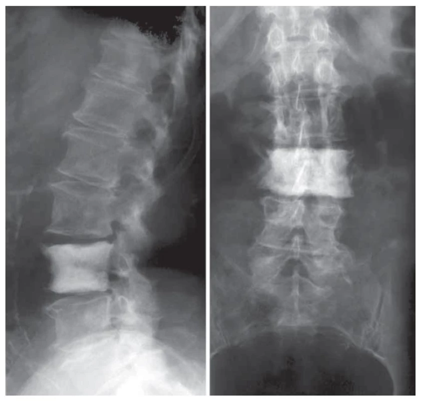Osteosklerotické změny bederního obratle u pacientky s POEMS
syndromem.