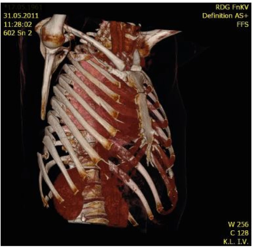 MDCT image of flail chest on the right