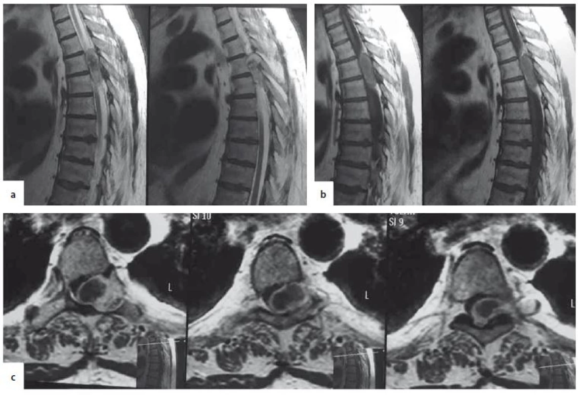 Spinal MRI. A – sagittal T2W, B – sagittal T1W, C – axial T1W. Extramedullary, inhomogeneous, thoracic lesion,
occupying the spinal canal, compressing the spinal cord and extending extraforaminally, enlarging the left
T5–6 foramen.<br>
T1W – T1-weighted image; T2W – T2-weighted image