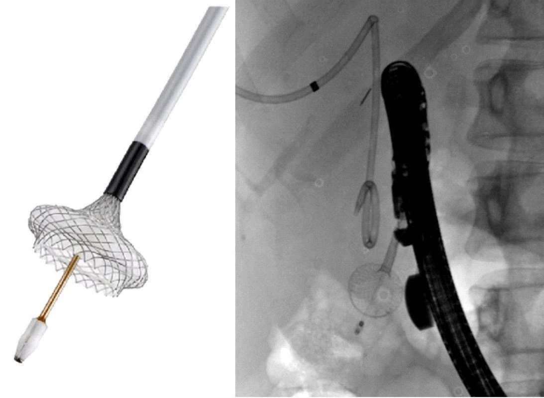 Rozvinutý distální flange (vlevo na schématu,
vpravo na RDG snímku naší pacientky)<br>
Fig. 3: Unfolded distal flange (left in the diagram; right in
the radiology scan of our patient)