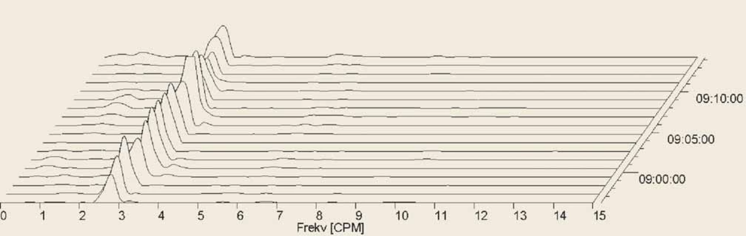 Electrogastrography (EGG), postprandial recording. Fourier transform. Only one patient had completely normal
EGG in all analysed settings, with three cycles per minute, during all the recording. It was a ??-year-old woman with systemic
sclerosis (SSc) diagnosed three months before the EGG investigation. Initial clinical manifestations were sclerodactyly,
fi ngertip lesions with pitting scars, abnormal nailfold capillaries found by nailfold capillaroscopy and SSc related
antibodies (anticentromera antibodies presence). Patient’s clinical presentation did correspond to a cutaneous limited
form of SSc.<br>
Elektrogastrografi e (EGG), postprandiální záznam. Fourierova transformace. Pouze jeden pacient měl během celého
záznamu se třemi cykly ve všech svodech zcela normální záznam. Jednalo se o 70letou ženu se systémovou sklerodermií
(SSc) diagnostikovanou 3 měsíce před vyšetřením EGG. Počáteční klinické projevy byly sklerodaktylie, jizvy na konečcích
prstů, abnormální kapiláry nehtových lůžek zjištěné kapilaroskopií a protilátky spojené s SSc (přítomnost protilátek proti centromerám).
Klinická prezentace pacienta odpovídala limitované kožní formě SSc.