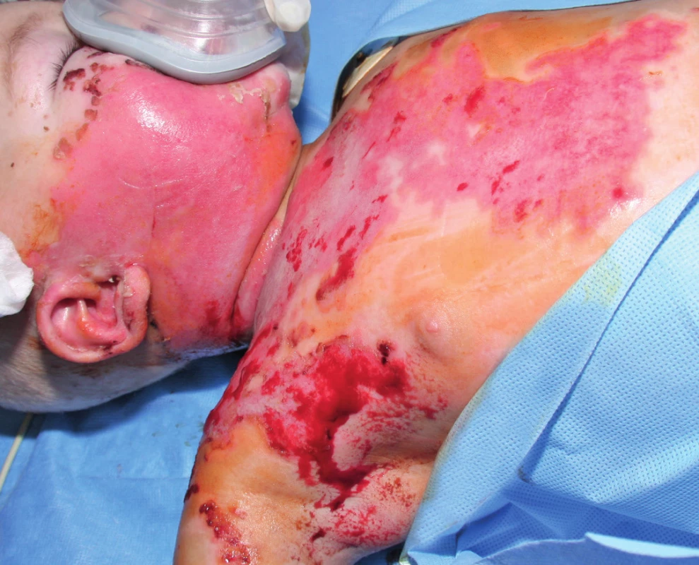 Post-burn day 15: Wound healing after three days of
acyclovir therapy