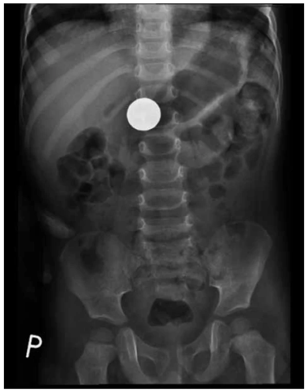 Mince 2 Kč v žaludku (49. den od spolknutí)<br>
Fig. 1. A coin (CZK 2) in the stomach (49th day from ingestion)