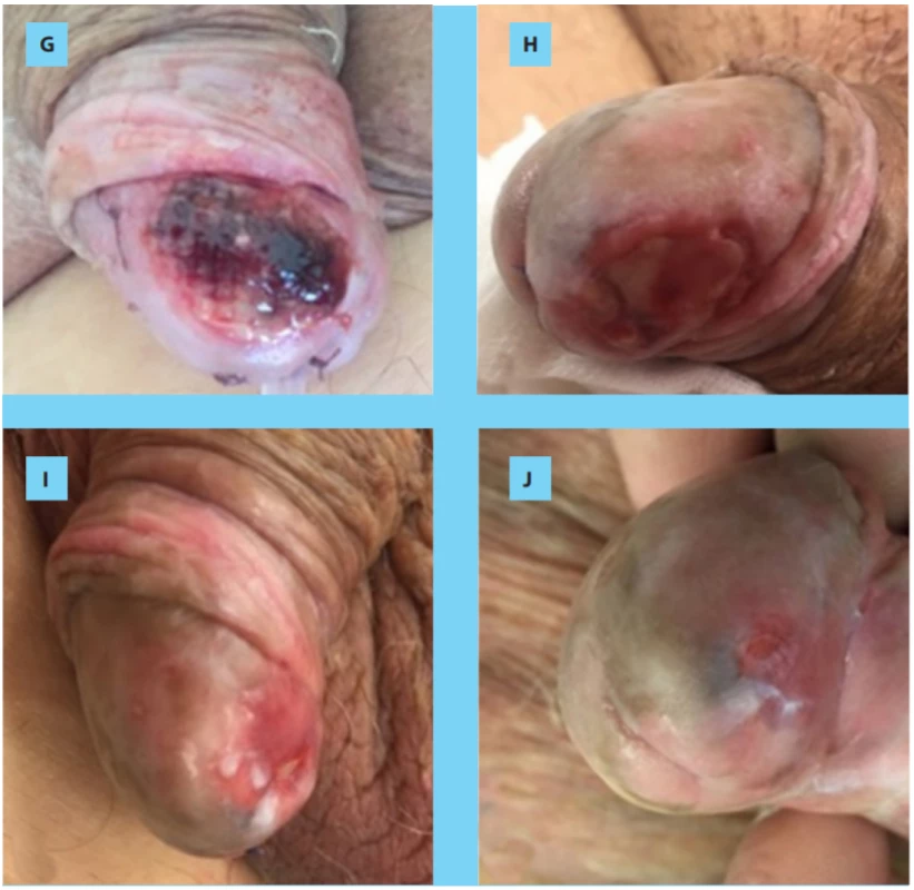 A) Low grade penile intraepithelial neoplasia PeN; B) The lesion measured approx. 20 mm and involved
less than 1/3 of the glans area; C) Sharp excision of the epithelium and subepithelial layer; D) Application of
the VerisetTM patch, which was fixed with few resorbable 5.00 sutures; E) Fat gauze was positioned over the
Veriset patch; F) 1st. postoperative day, fragments of the patch are still in situ; G) 3rd postoperative day – the
base is already partially granulated; H) 1 week after the procedure; I) 4 weeks after; J) after 8 weeks the wound
was completely epithelialized and exhibited satisfactory cosmetic appearance.<br>
Obr. 1. A) Penilní intraepitelová neoplazie nízkého stupně; B) léze měřila přibližně 20 mm a postihovala méně
než 1/3 povrchu glandu; C) ostrá excize epitelu a subepitelové vrstvy; D) aplikace náplasti VerisetTM, která byla připevněna několika vstřebatelnými stehy 5/00; E) mastná gáza umístěna přes náplast Veriset; F) první pooperační
den, fragmenty náplasti jsou stále in situ; G) třetí pooperační den – spodina je již částečně granulovaná; H) jeden
týden po zákroku; I) čtyři týdny po zákroku; J) po osmi týdnech byla rána kompletně epitelizovaná a vykazovala
uspokojivý estetický vzhled.