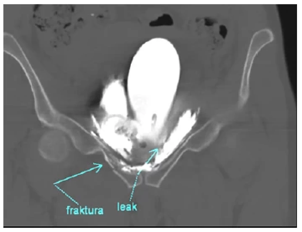 CT cystografie, extraperitenální ruptura
močového měchýře, frakura ramének kosti stydké,
značeno modrou šipkou <br> 
Fig. 2. CT cytography, extraperitoneal rupture of
urinary bladder, fracture of pubic rami, marked with
a blue arrow
