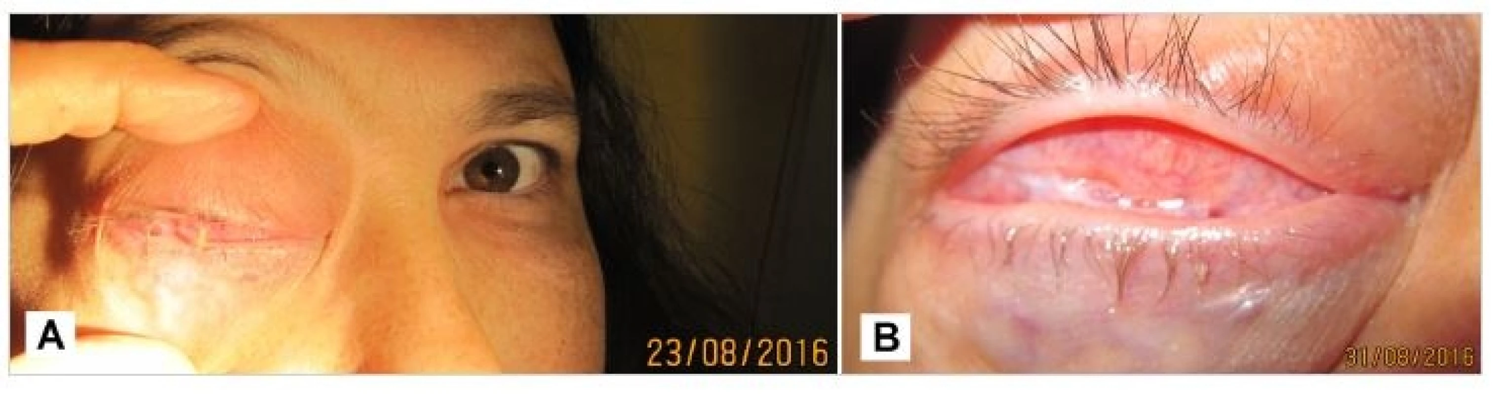 Patient in 8/2016, progression of tumor masses in the right orbit (A), detail of conjunctival sac - conjunctiva with scar, symplepharon