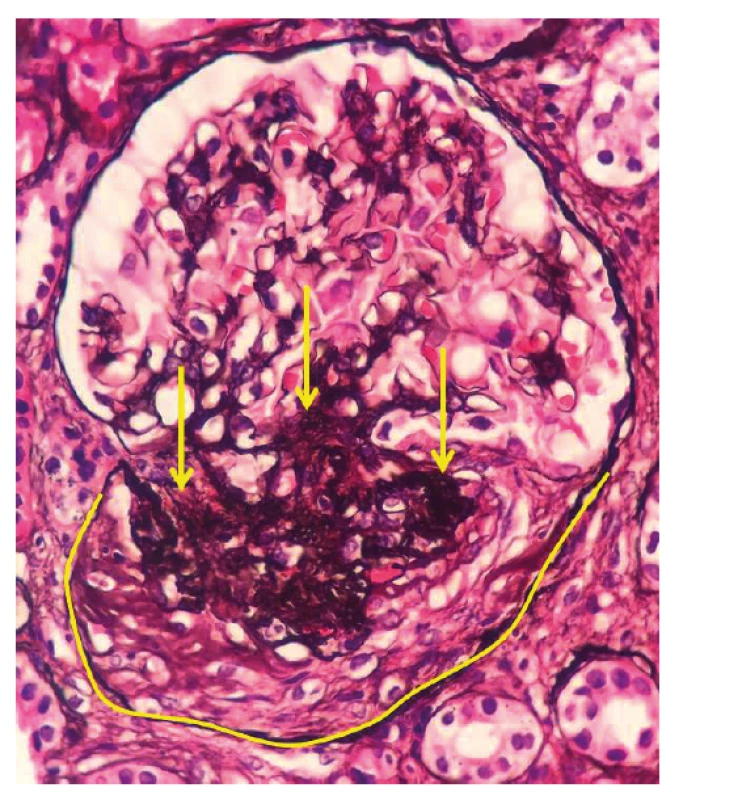 Fotodokumentace druhé renální biopsie provedené
v roce 2018