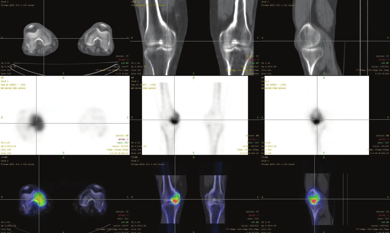 Fúze SPECT/CT obrazu u téhož pacienta s osteonekrózou mediálního kondylu femuru v časném stádiu (I). V horní řadě je obraz
z LDCT postupně v transaxiální, koronární a sagitální rovině. Střední řada ukazuje odpovídající SPECT řezy. Dolní řada prezentuje odpovídající
fúzované SPECT/CT řezy. Scintigrafický nález je v časném stádiu výrazný, nález na LDCT normální.