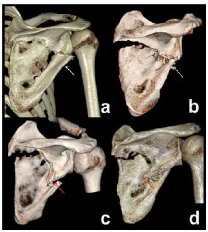 Types of two-part infraspinous fractures of scapular
body, different courses of fracture line. a – immediately
below to inferior glenoid rim, b – at the level of the
origin of the long head of triceps, c – through the circumflex
notch, d – on the border between the superior and
inferior halves of the lateral pillar. White arrow – circumflex
notch, red arrow – spike of superior fragment. Note
the different types of fragment displacement (translation
versus angulation with fragment overlap).