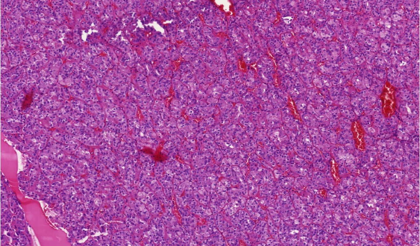 Typický ESC (eosinofilní solidní a cystický renální
karcinom)<br>
Fig. 4. Typical ESC (eosinophilic solid and cystic
renal cell carcinoma)