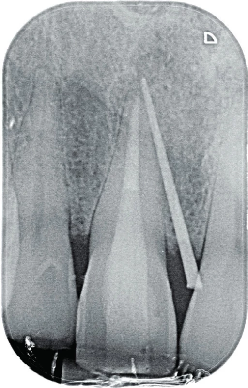 Fistulografie horního
frontálního úseku dva
roky po reendodontickém
ošetření zubu 11. Zavedený
gutaperčový čep ve fistule
směřuje k apexu zubu 11.
Projasnění je na tomto
snímku zřetelné